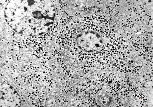 F, 71y. | carcinoid … metastasis to lymphonode F, 71y. | carcinoid … metastasis to lymphonode